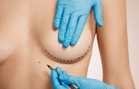 Explantaci&oacute;n mamaria: por qu&eacute; cada vez m&aacute;s mujeres deciden retirar sus implantes