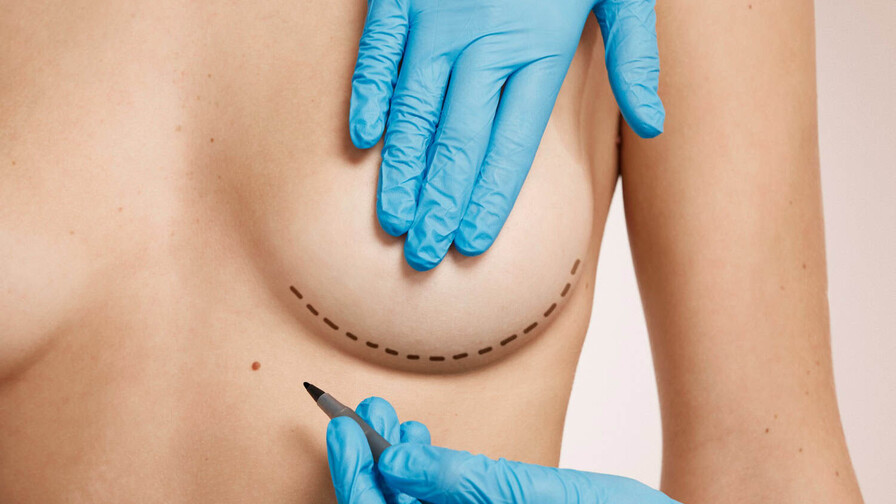 Explantación mamaria: por qué cada vez más mujeres deciden retirar sus implantes Explantación mamaria: por qué cada vez más mujeres deciden retirar sus implantes