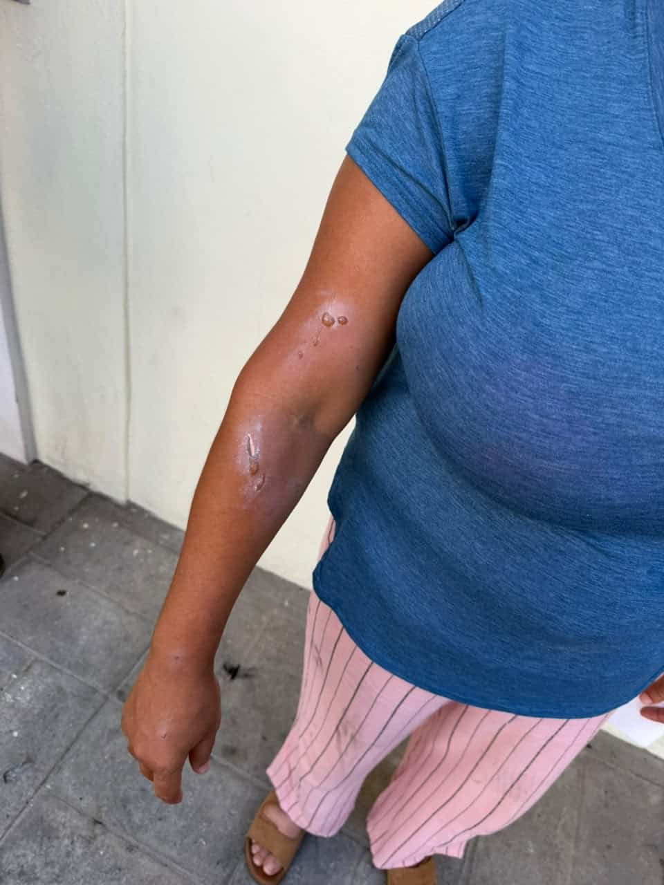 Quemaduras en el antebrazo de Emily Núñez Mayor.