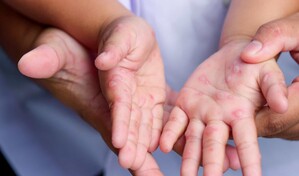 Enterovirus Coxsackie: responsable de la enfermedad boca-mano-pie
