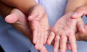 Enterovirus Coxsackie: responsable de la enfermedad boca-mano-pie