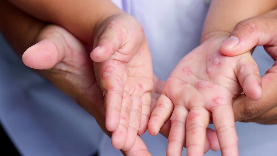 Enterovirus Coxsackie: responsable de la enfermedad boca-mano-pie Enterovirus Coxsackie: responsable de la enfermedad boca-mano-pie