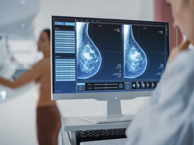 Detección cáncer de mama: 113 confirmadas y 5 muertas desde 2021