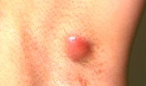 Hidrosadenitis o golondrinos y las molestias que causan en quienes los padecen 