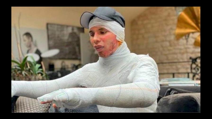 Así quedó el diseñador Olivier Rousteing tras explosión en su casa