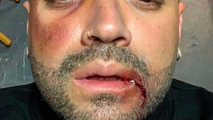 Cantante Nacho sube fotografía con el rostro golpeado y sus detractores explotan en su contra 