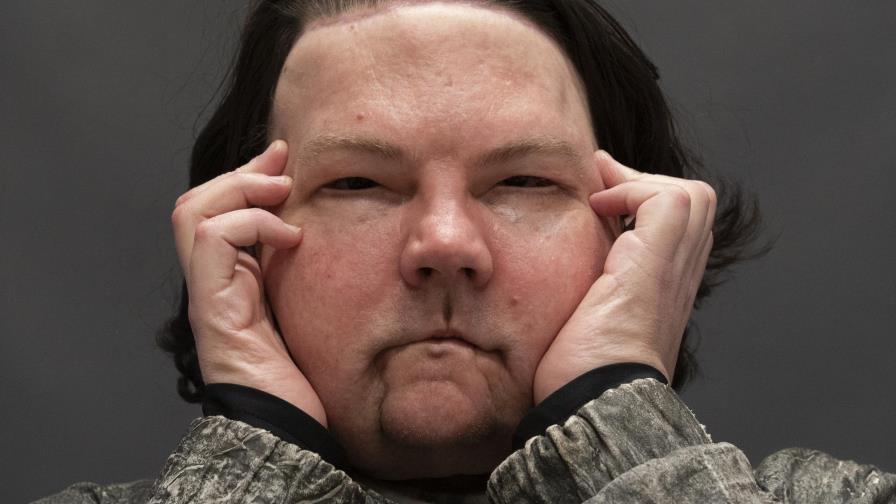 Hombre recibe trasplante de cara y ambas manos