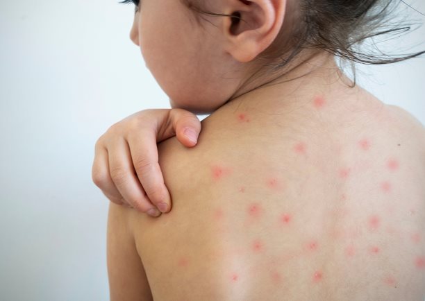 La vacuna contra la varicela, una protección que debes dar a tus hijos
