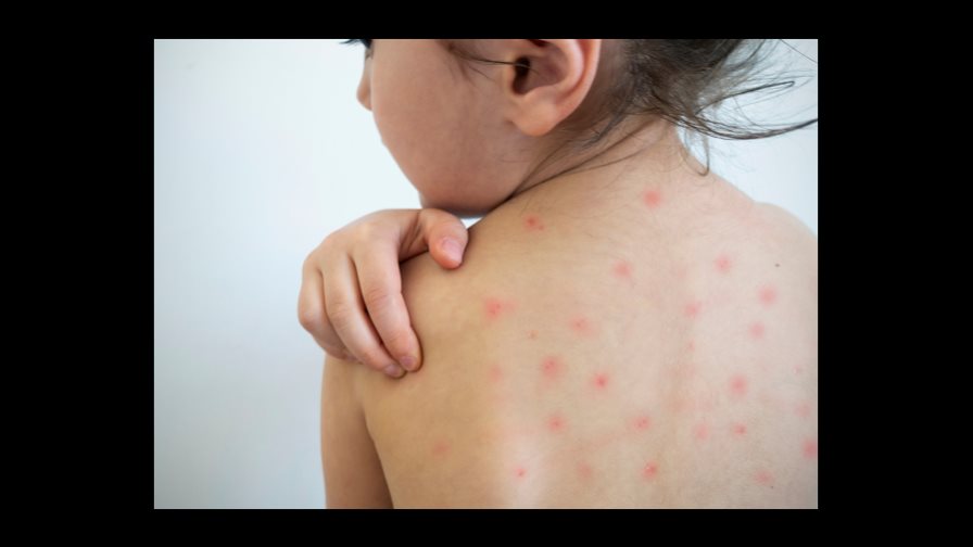 La vacuna contra la varicela, una protección que debes dar a tus hijos