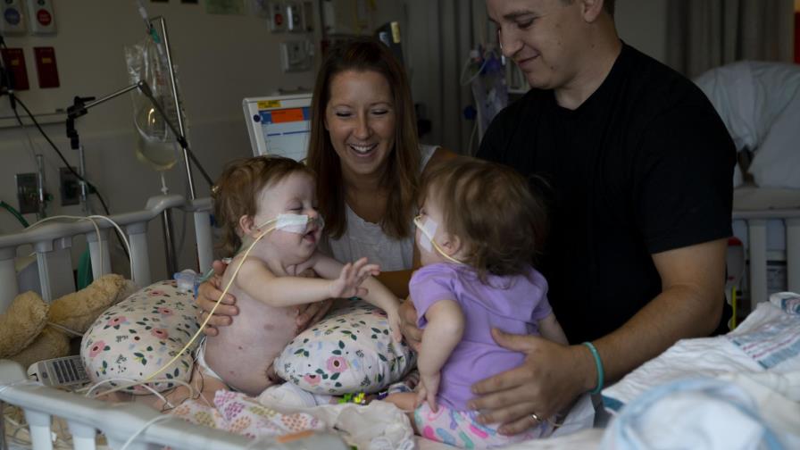 Separan a siamesas de un año en Michigan