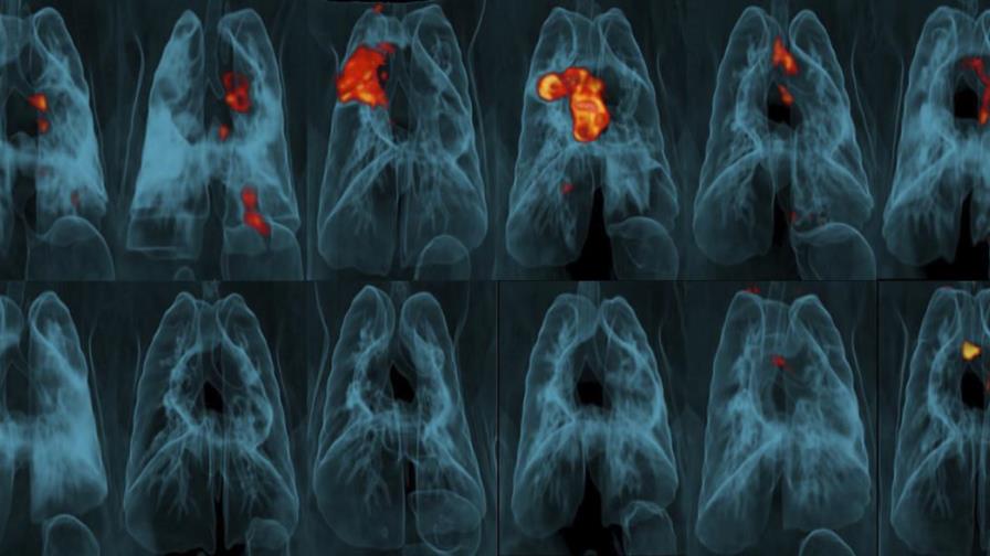 Estudio: Vacuna contra tuberculosis es mejor intravenosa