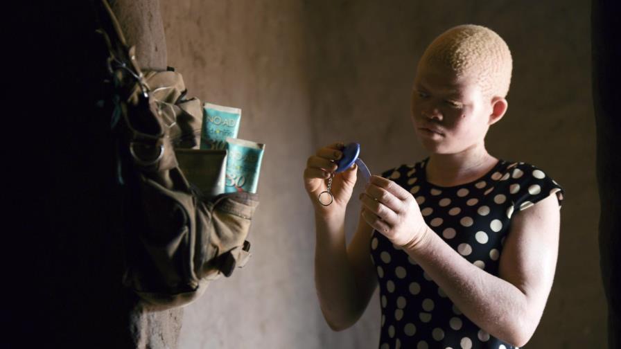 Supersticiones que pueden costar la vida a albinos en África Supersticiones que pueden costar la vida a albinos en África