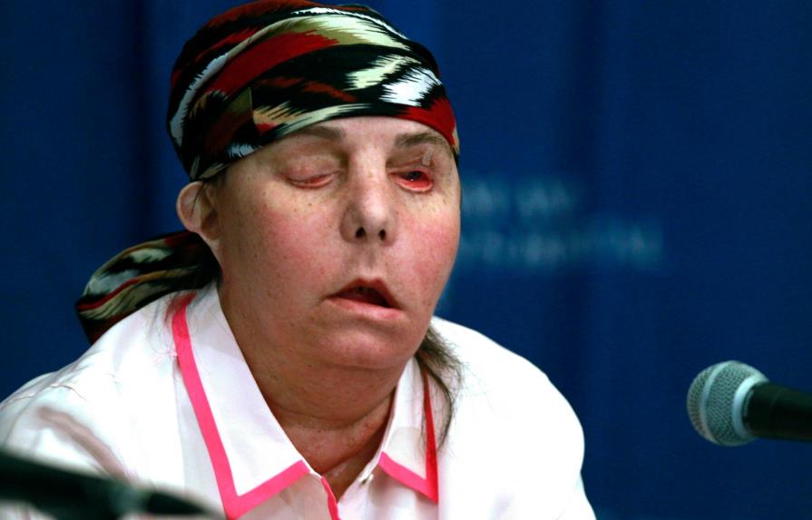 Realizan segundo trasplante de cara a una mujer atacada por exesposo 