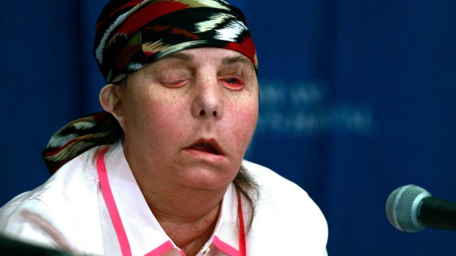 Realizan segundo trasplante de cara a una mujer atacada por exesposo 