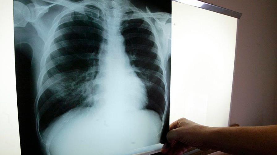 Médicos Sin Fronteras dice haber encontrado mejor tratamiento para la tuberculosis Médicos Sin Fronteras dice haber encontrado mejor tratamiento para la tuberculosis