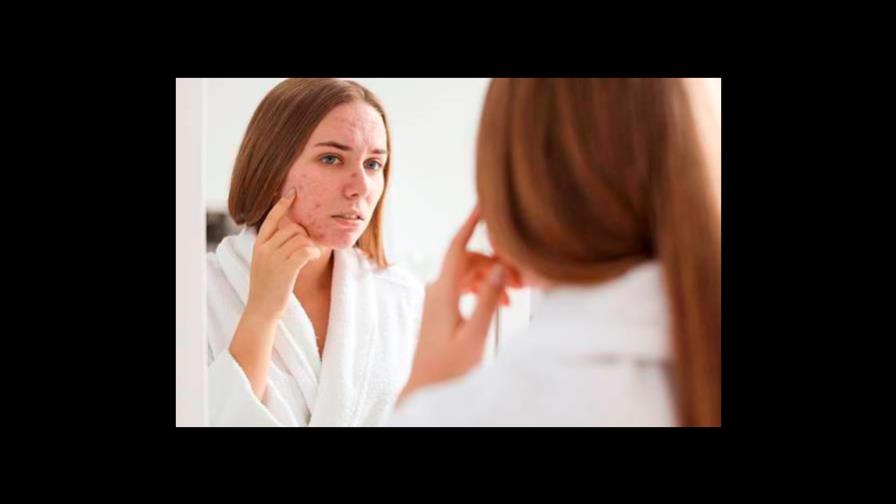 ¿Cuál es la relación entre el acné y los métodos anticonceptivos?