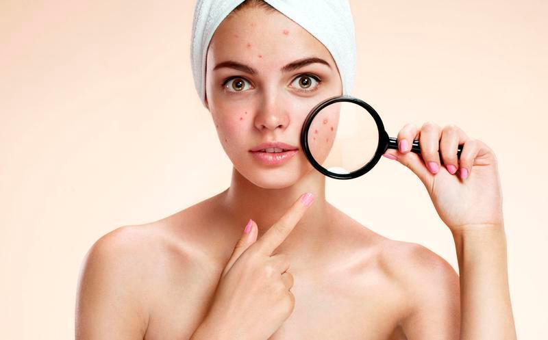 ¿Cuál es tu tipo de acné y cómo tratarlo?