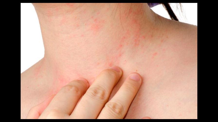 Alergias afectan calidad de vida de pacientes y pueden derivar en depresión Alergias afectan calidad de vida de pacientes y pueden derivar en depresión