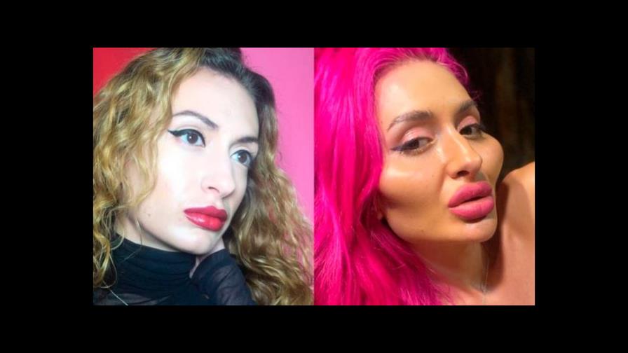 La mujer con las mejillas más grandes del mundo y su brutal metamorfosis