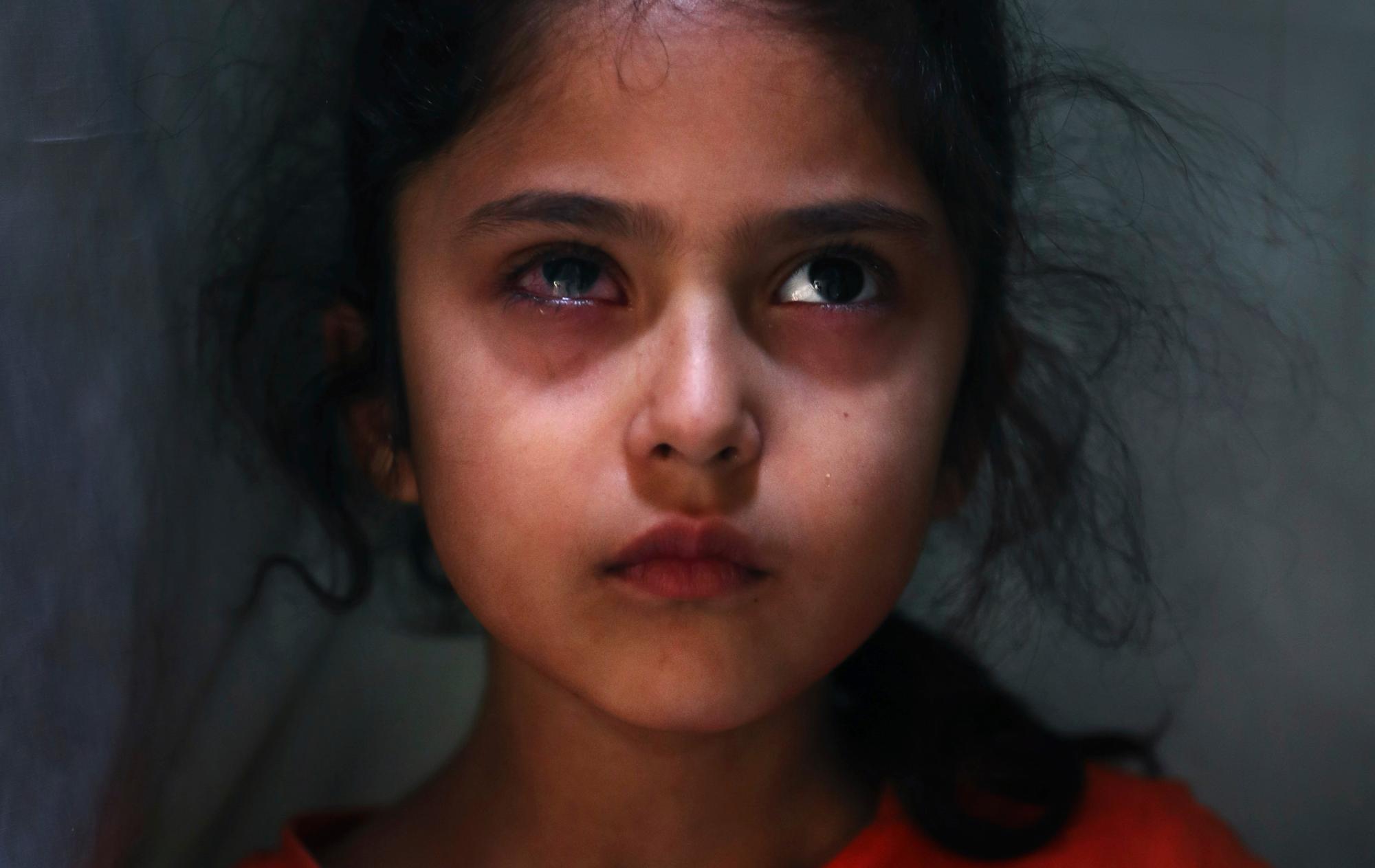 Muneefa Nazir, de seis años, una niña de Cachemira cuyo ojo derecho fue golpeado por una bola de mármol disparada supuestamente por soldados paramilitares indios el 12 de agosto, se encuentra frente a su casa en Srinagar, Cachemira controlada por la India el 17 de septiembre de 2019. 