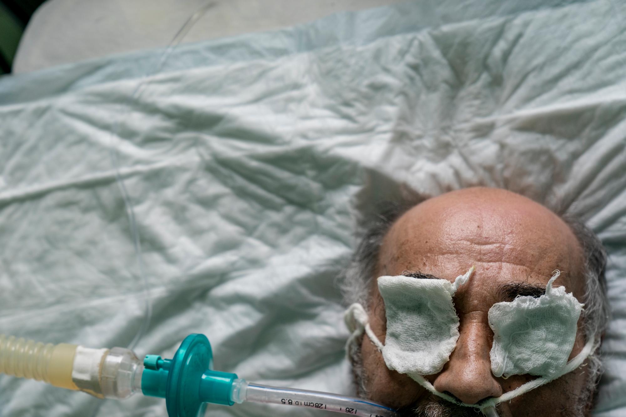 En esta foto tomada el lunes 4 de mayo de 2020, un paciente con coronavirus respira con una máscara de oxígeno en una unidad de cuidados intensivos en un hospital regional en Chernivtsi, Ucrania. El problemático sistema de salud de Ucrania ha sido abrumado por COVID-19, a pesar de que ha reportado un número relativamente bajo de casos. (Foto AP / Evgeniy Maloletka)