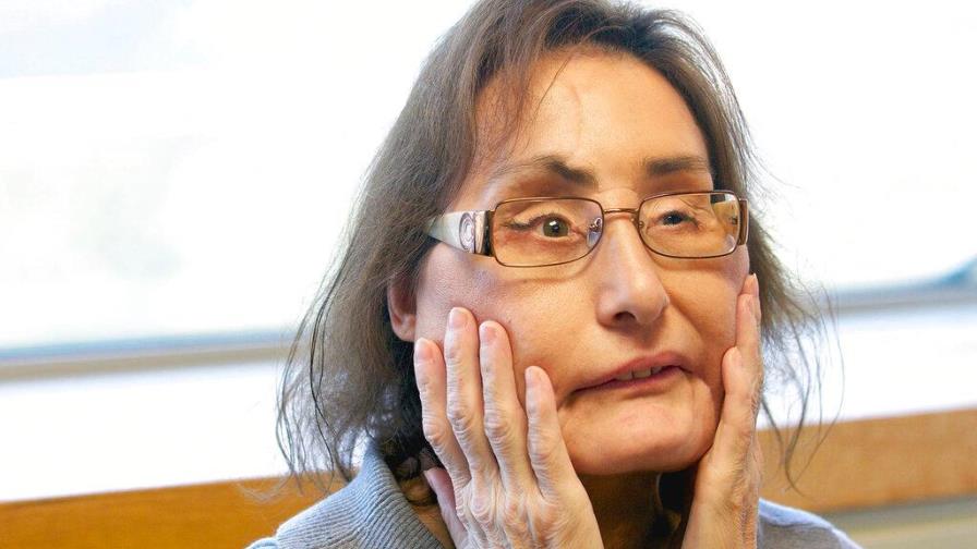 Muere 12 años después primera receptora de trasplante facial en EE.UU.