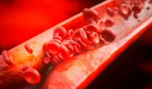 Aterosclerosis subclínica