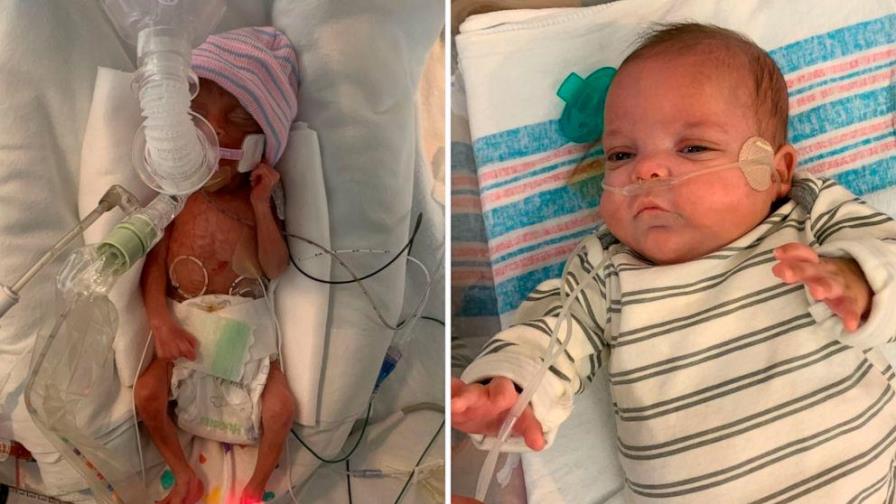 Dan de alta a bebé que nació pesando solo una libra Dan de alta a bebé que nació pesando solo una libra