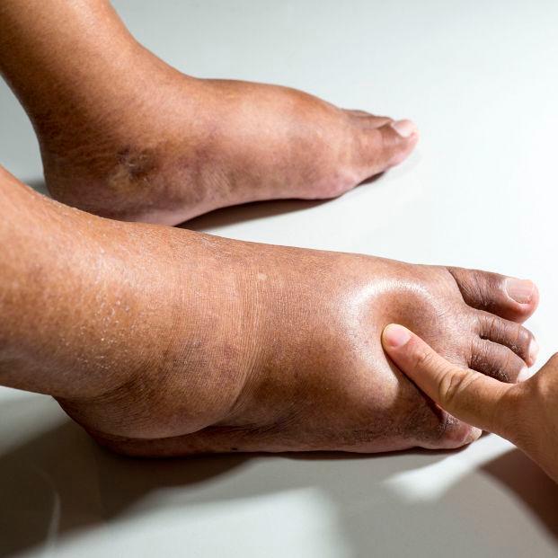 Hospitales exhiben curación del 90% de los pacientes con úlceras del pie diabético 