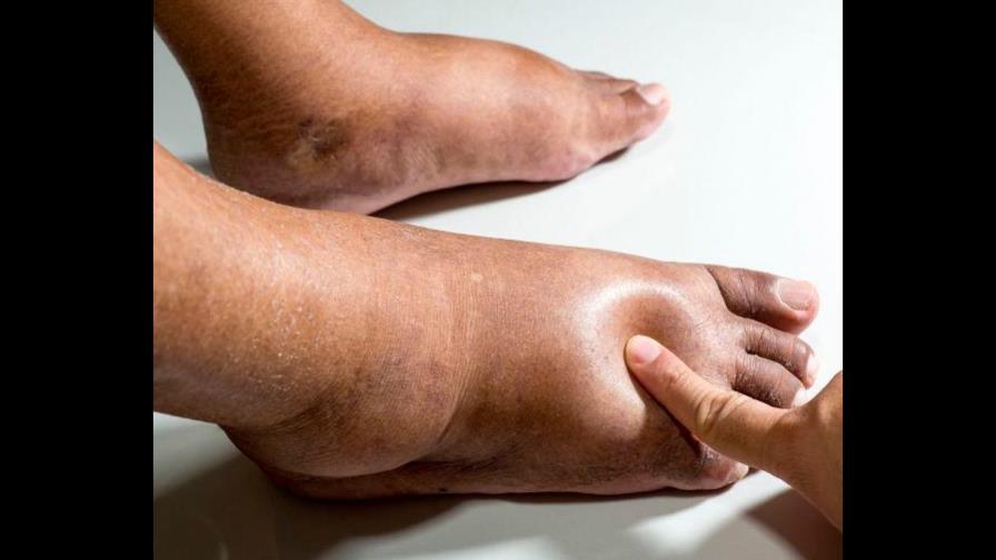 Hospitales exhiben curación del 90% de los pacientes con úlceras del pie diabético 