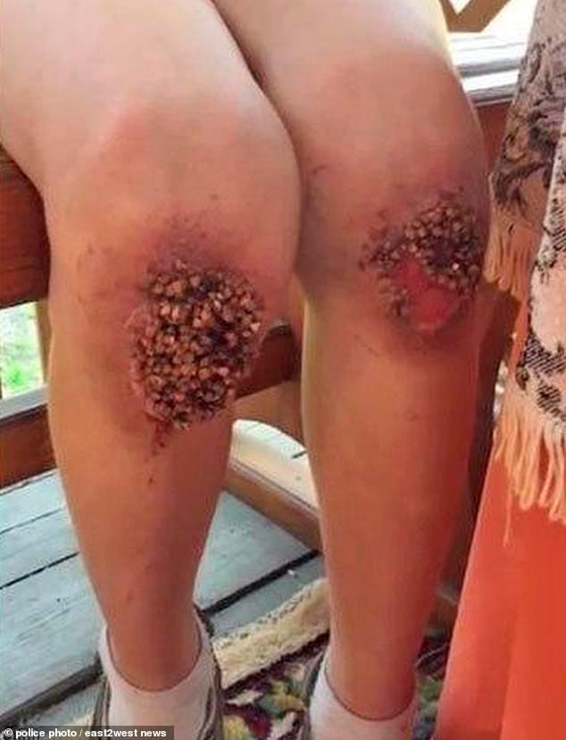 Así quedaron las rodillas del infante.