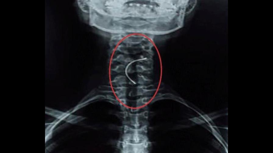 Joven se perfora la garganta luego de tragarse sus brackets 