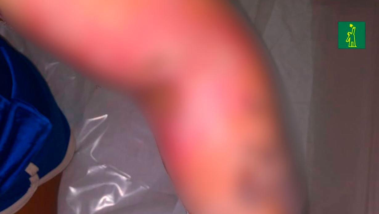 Con dos operaciones para colocar piel, el brazo tendrá movilidad, indican los médicos a Gabriela.