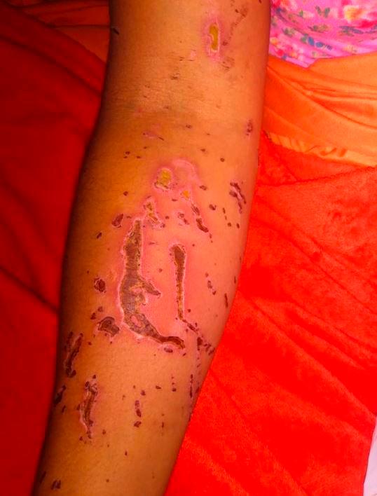 El ácido le salpicó en varias partes del cuerpo. 