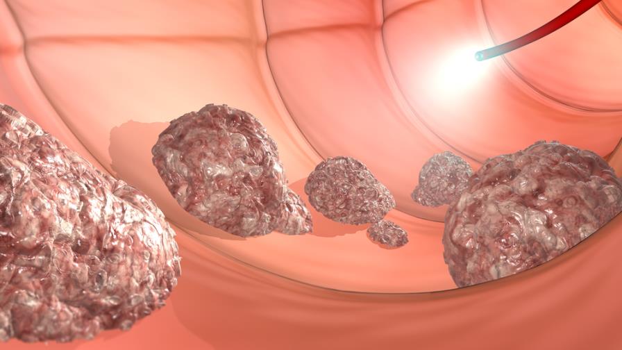 El cáncer de colorrectal afecta a más de 1,400 dominicanos cada año