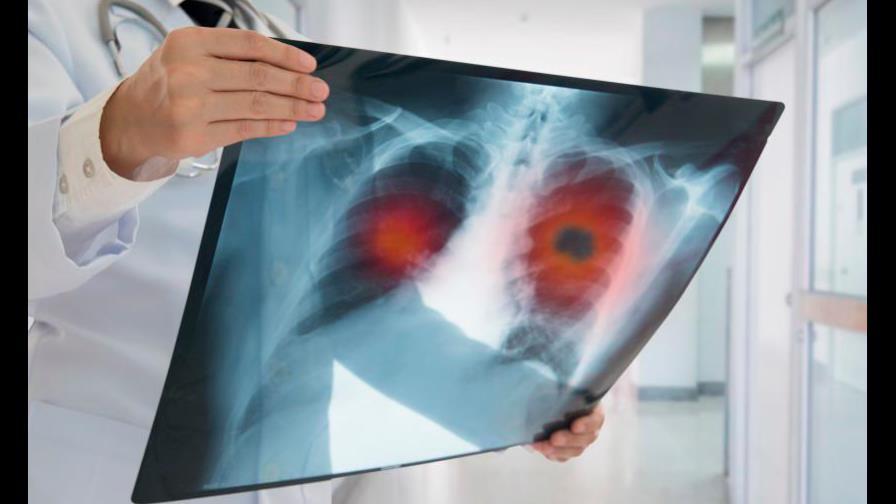 Los problemas pulmonares son las principales secuelas del COVID-19