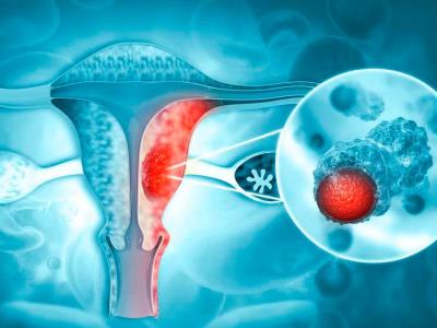 OMS: Vacuna contra cáncer de cuello uterino puede evitar muertes