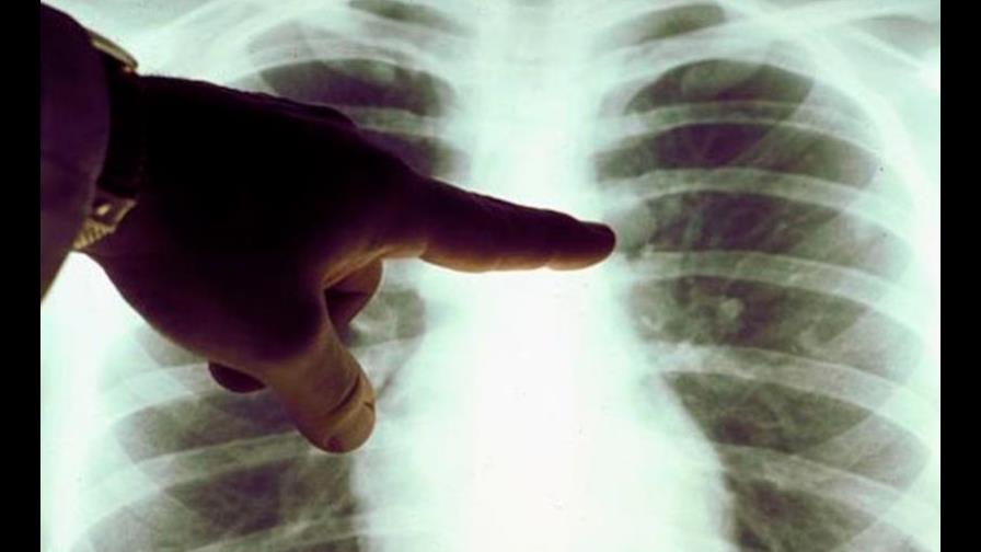 Cáncer de pulmón, el más letal y el que menos atención recibe en Latinoamérica