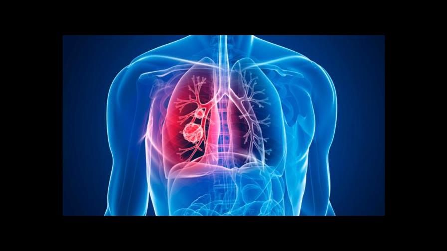 Especialistas temen que COVID-19 eleve casos de cáncer de pulmón