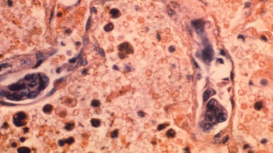Descubren cómo un ácido graso de aceite de palma aumenta riesgo de metástasis Descubren cómo un ácido graso de aceite de palma aumenta riesgo de metástasis