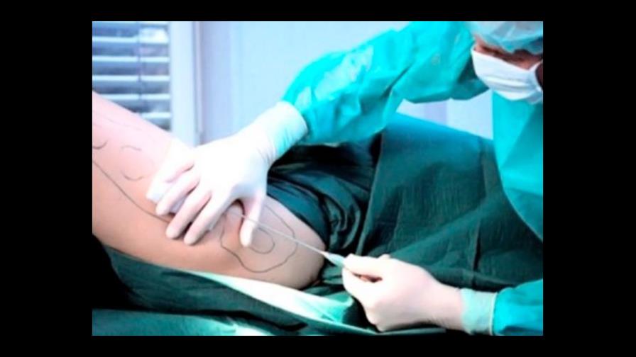 Qué es la lipectomía por succión, procedimiento por el cual murió madre de Yatnna Rivera