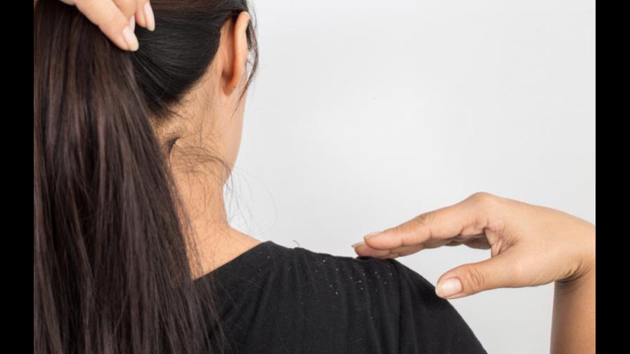 Combate la caspa con estos ingredientes de tu cocina