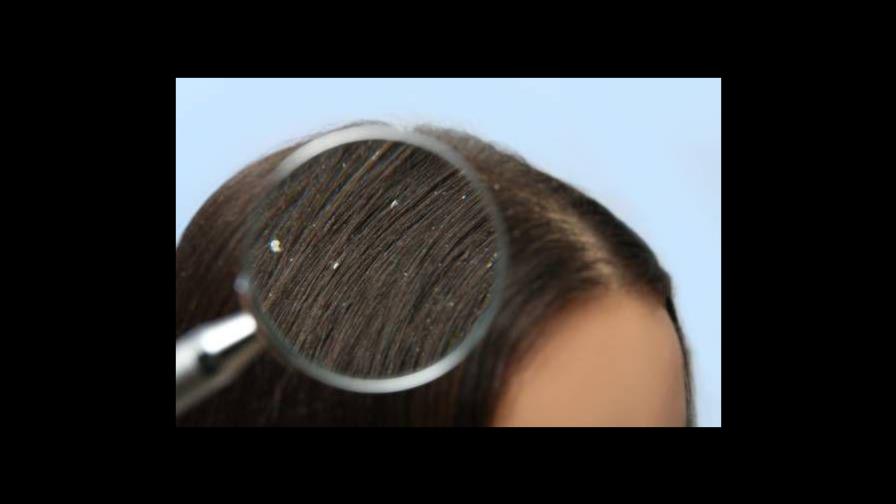 ¿Caspa? Estos consejos te ayudarán a librarte de ella