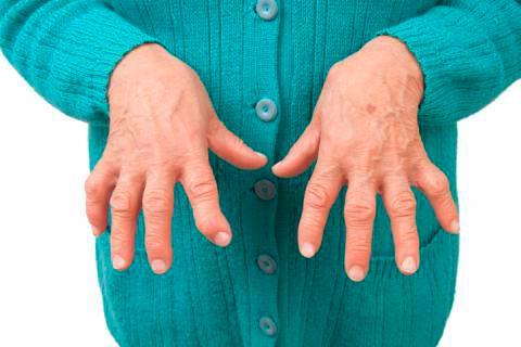 Reumatóloga destaca tratamientos para artritis reumatoide
