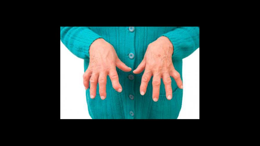 Reumatóloga destaca tratamientos para artritis reumatoide