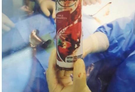 Critican que Moscoso Puello diera a conocer hasta la foto de cirugía a hombre con frasco en el recto