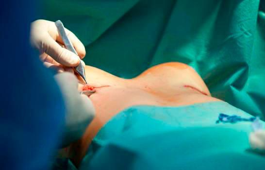 Fundación Vargas Almonte hará jornada quirúrgica a mujeres con gigantomastia