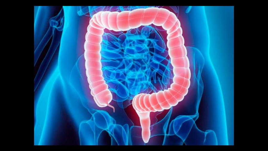 El cáncer colorrectal: el segundo tipo más mortal en el 2020, con 935,000 muertes