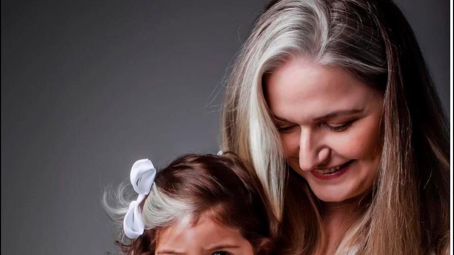 Una niña brasileña nace con canas debido a una rara condición genética 
