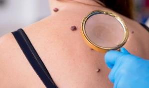 La incidencia de melanoma aumenta en 600 veces a nivel mundial en 20 años